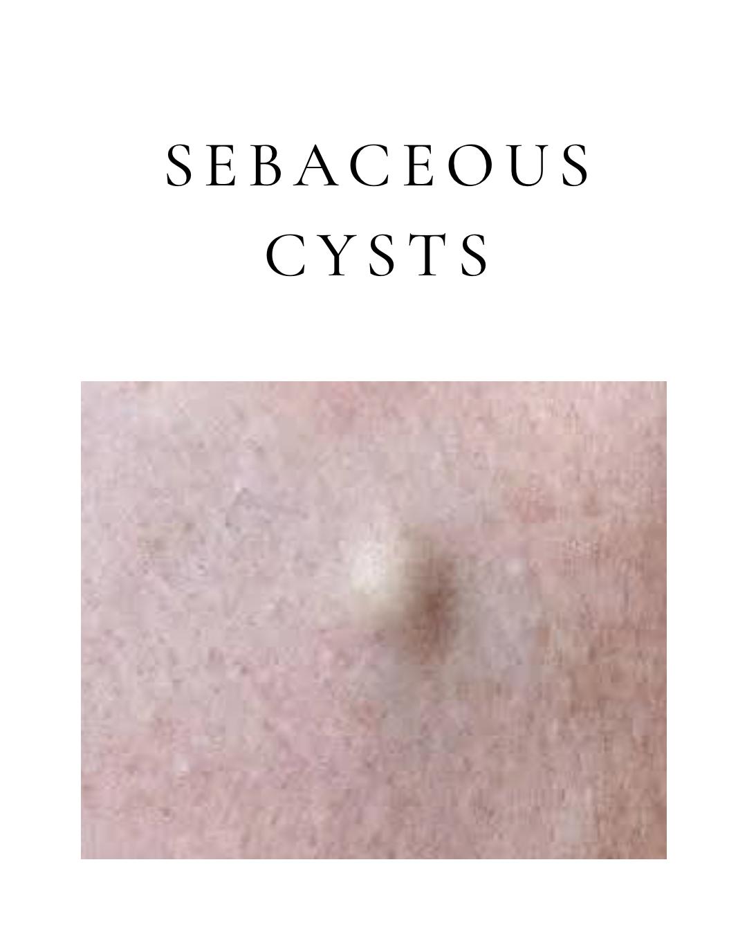 Sebaceous Cysts